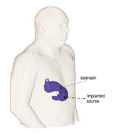 Implants in Digital Phantoms